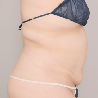 お腹・胸下・腰の脂肪吸引【術前／6ヶ月後 34歳女性】