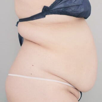 お腹・胸下・腰の脂肪吸引【術前／6ヶ月後 34歳女性】