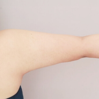 二の腕・肩・太もも・お尻・膝の脂肪吸引【術前／1ヶ月後 25歳女性】