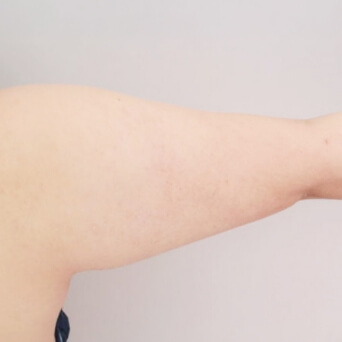 二の腕・肩・太もも・お尻・膝の脂肪吸引【術前／1ヶ月後 25歳女性】