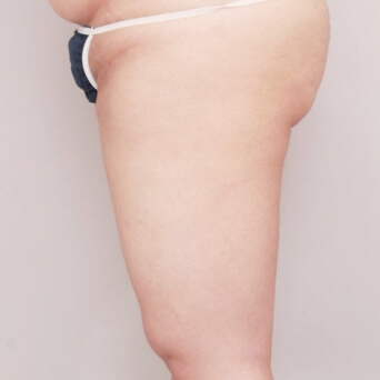 二の腕・肩・太もも・お尻・膝の脂肪吸引【術前／1ヶ月後 25歳女性】