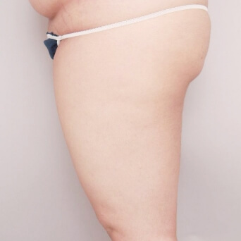 二の腕・肩・太もも・お尻・膝の脂肪吸引【術前／1ヶ月後 25歳女性】