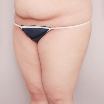 二の腕・肩・太もも・お尻・膝の脂肪吸引【術前／1ヶ月後 25歳女性】