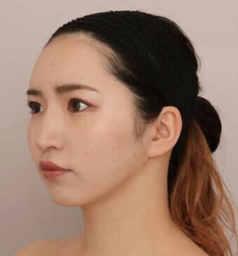 全身の脂肪吸引＋脂肪注入豊胸＋お尻の脂肪注入【術前／6ヶ月後 29歳女性】