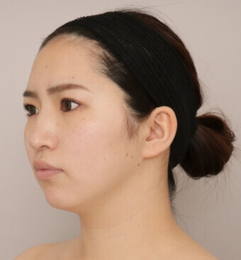 全身の脂肪吸引＋脂肪注入豊胸＋お尻の脂肪注入【術前／6ヶ月後 29歳女性】