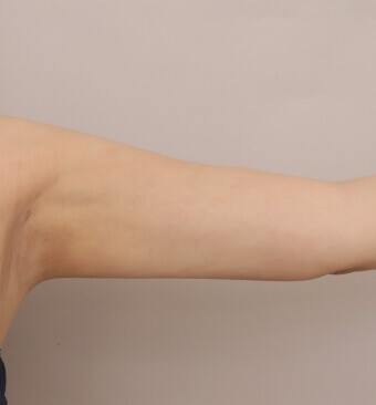 全身の脂肪吸引＋脂肪注入豊胸＋お尻の脂肪注入【術前／6ヶ月後 29歳女性】