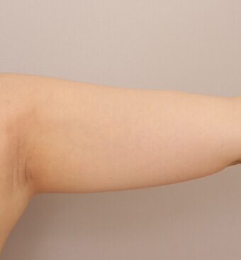 全身の脂肪吸引＋脂肪注入豊胸＋お尻の脂肪注入【術前／6ヶ月後 29歳女性】