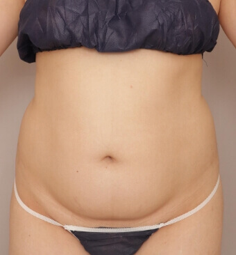 全身の脂肪吸引＋脂肪注入豊胸＋お尻の脂肪注入【術前／6ヶ月後 29歳女性】