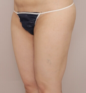 全身の脂肪吸引＋脂肪注入豊胸＋お尻の脂肪注入【術前／6ヶ月後 29歳女性】