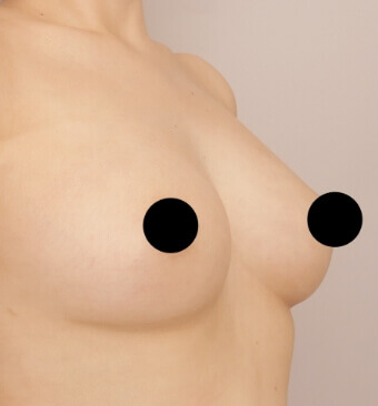 全身の脂肪吸引＋脂肪注入豊胸＋お尻の脂肪注入【術前／6ヶ月後 29歳女性】