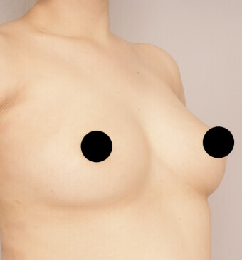 全身の脂肪吸引＋脂肪注入豊胸＋お尻の脂肪注入【術前／6ヶ月後 29歳女性】