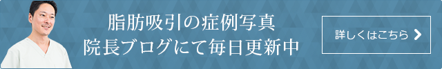 脂肪吸引の症例写真 院長ブログにて毎日更新中