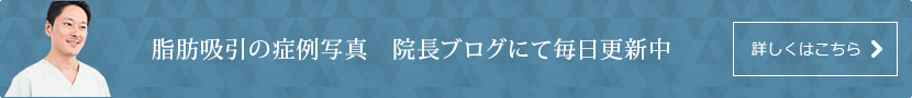 脂肪吸引の症例写真 院長ブログにて毎日更新中