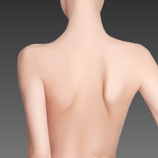 背中のベイザー脂肪吸引