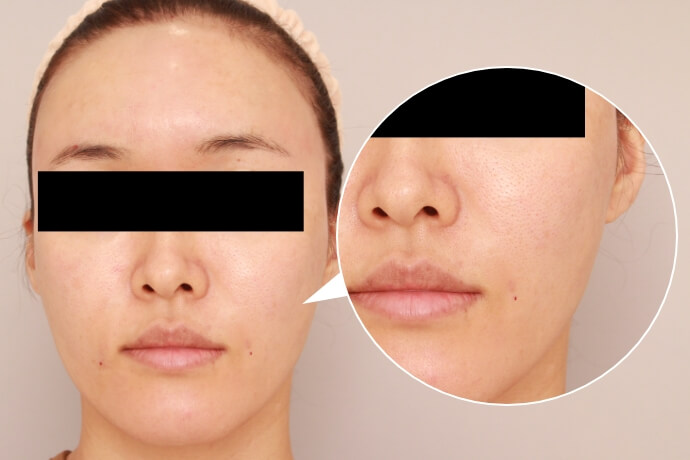 お顔全体の脂肪注入【40歳女性 術前/術直後】