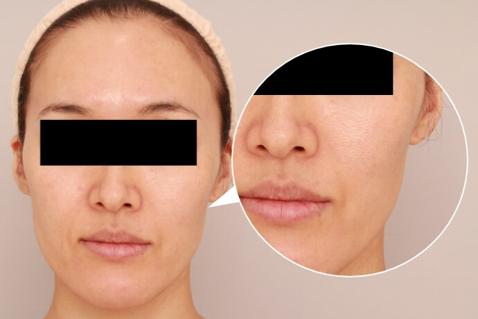 お顔全体の脂肪注入【40歳女性 術前/術直後】