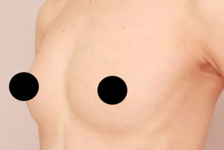 授乳後のコンデンスリッチ豊胸【40歳女性 術前/術後6ヶ月】