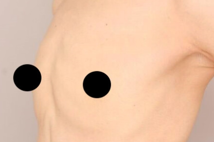 授乳後のコンデンスリッチ豊胸【40歳女性 術前/術後6ヶ月】