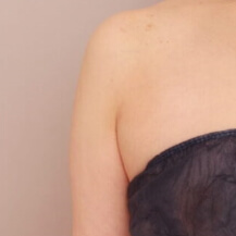 産後の脂肪吸引+授乳後のコンデンスリッチ豊胸【47歳女性 術前/術後3ヶ月】