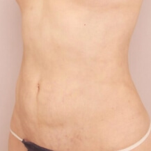 産後の脂肪吸引+授乳後のコンデンスリッチ豊胸【47歳女性 術前/術後3ヶ月】