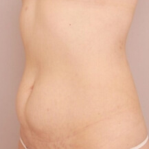 産後の脂肪吸引+授乳後のコンデンスリッチ豊胸【47歳女性 術前/術後3ヶ月】