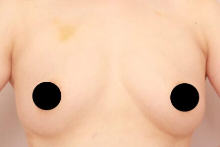 産後の脂肪吸引+授乳後のコンデンスリッチ豊胸【47歳女性 術前/術後3ヶ月】