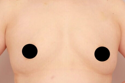 産後の脂肪吸引+授乳後のコンデンスリッチ豊胸【47歳女性 術前/術後3ヶ月】