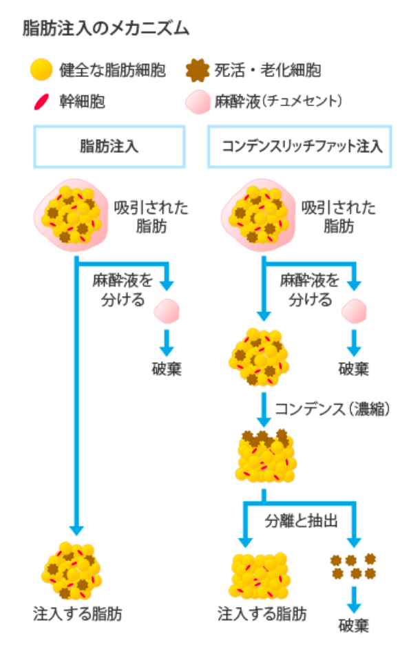 従来の脂肪注入のしこりリスクを軽減の図説