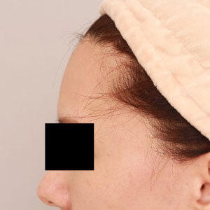 おでこのコンデンスリッチフェイス【術前／1ヶ月 46歳女性】の術後写真