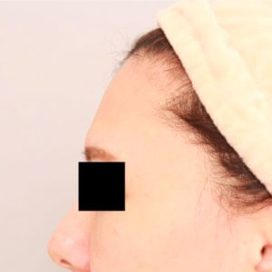 おでこのコンデンスリッチフェイス【術前／1ヶ月 46歳女性】の術前写真