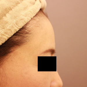 おでこのコンデンスリッチフェイス【術前／1ヶ月 49歳女性】の術後写真