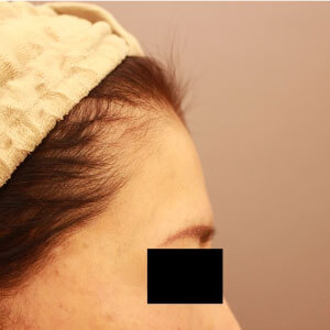 おでこのコンデンスリッチフェイス【術前／1ヶ月 49歳女性】の術前写真