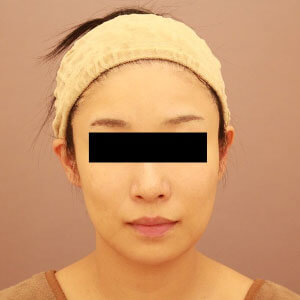 頬のコンデンスリッチフェイス【術前／4ヶ月 36歳女性】の術後写真