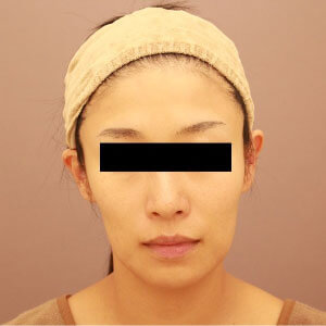 頬のコンデンスリッチフェイス【術前／4ヶ月 36歳女性】の術前写真