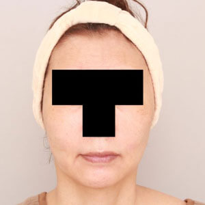 お顔全体（頬・おでこ・こめかみ）のコンデンスリッチフェイス【術前／1ヶ月 60歳女性】の術後写真