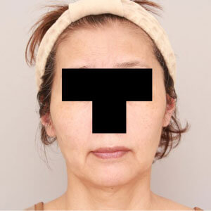 お顔全体（頬・おでこ・こめかみ）のコンデンスリッチフェイス【術前／1ヶ月 60歳女性】の術前写真