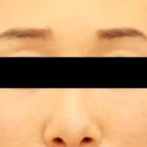 脂肪注入 マイクロcrf Mods Clinic モッズクリニック 公式 東京 銀座 大阪