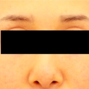 目の上のくぼみの脂肪注入【術前／術後6ヶ月 46歳女性】の術前写真