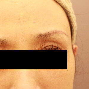 目の上のくぼみの脂肪注入【術前／術後4ヶ月 51歳女性】の術後写真