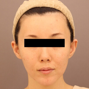 頬、おでこ、こめかみ、ほうれい線の脂肪注入【術前／術後1ヶ月 29歳女性】の術後写真