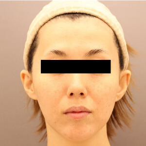 頬、おでこ、こめかみ、ほうれい線の脂肪注入【術前／術後1ヶ月 29歳女性】の術前写真