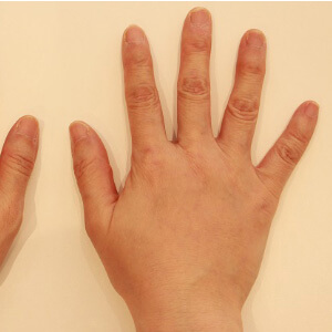 手の甲の脂肪注入【術前／術後10ヶ月 51歳女性】の術後写真