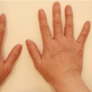 手の甲の脂肪注入【術前／術後10ヶ月 51歳女性】の術前写真