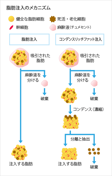 脂肪注入のメカニズム