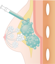 まとめて注入した場合のリスク