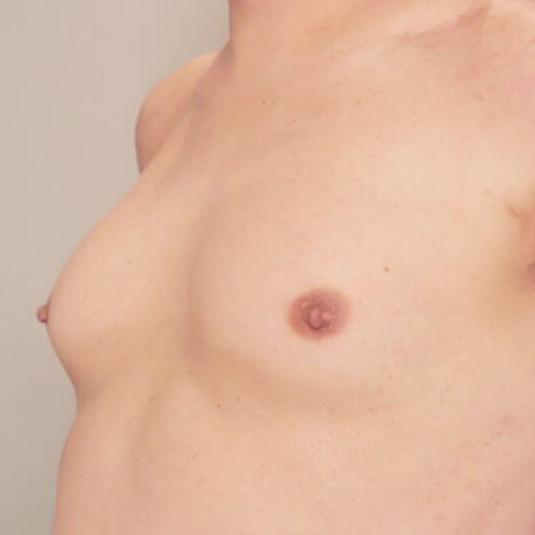 コンデンスリッチ豊胸【術前／1ヶ月後 50代 ホルモン治療なし】の術後写真
