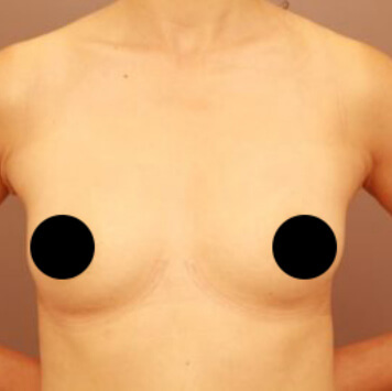 授乳後のコンデンスリッチ豊胸【術前／6ヶ月 35歳女性】の術後写真