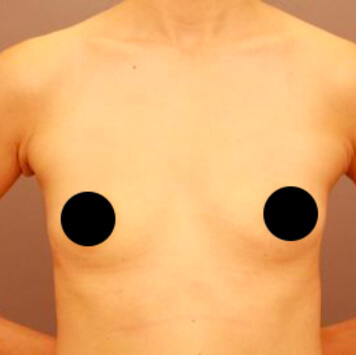 授乳後のコンデンスリッチ豊胸【術前／6ヶ月 35歳女性】の術前写真