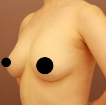 授乳後のコンデンスリッチ豊胸【術前／3ヶ月 33歳女性】の術後写真