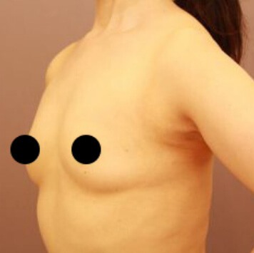 授乳後のコンデンスリッチ豊胸＋乳頭縮小【術前／3ヶ月 47歳女性】の術前写真